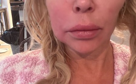 Everything Brandi Glanville Has Said About Her Facial Disfigurement