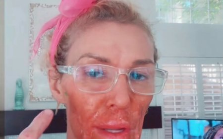 Brandi Glanville Seemingly Burns Herself After Putting Nair on Her Face