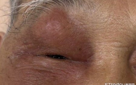 老翁眼皮腫到睜不開　醫揪出「鼻竇炎」害眼周塞滿膿瘍