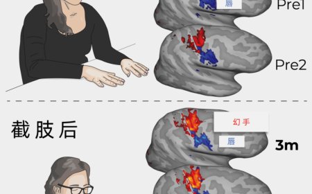 为何截肢后还会幻痛？