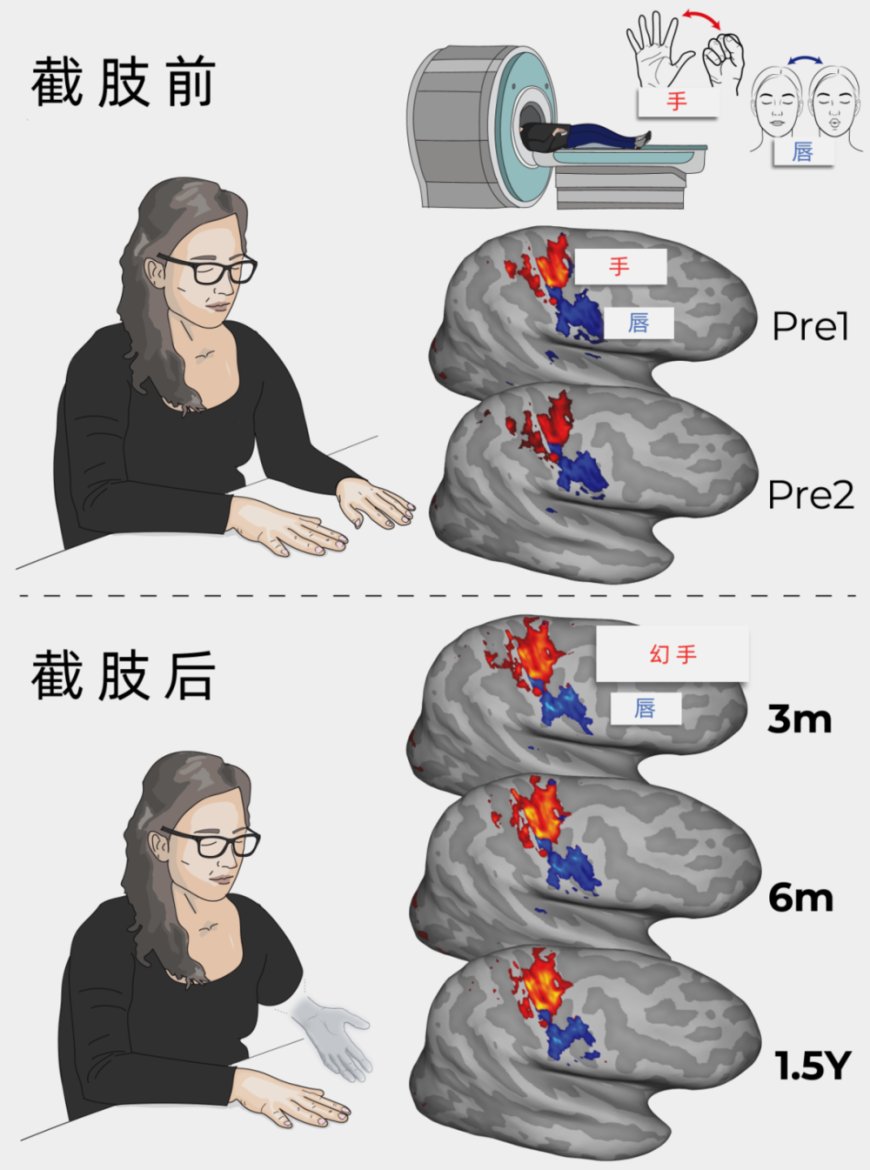 为何截肢后还会幻痛?