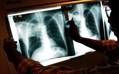 Three active tuberculosis cases reported in Maine as deadly disease continues to tick up across country
