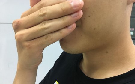 少年「每分鐘打嗝40次」痛苦休學　「浮針」7次治療奇蹟痊癒