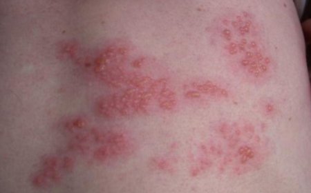 帶狀疱疹防治關鍵　疫苗接種是最佳保護