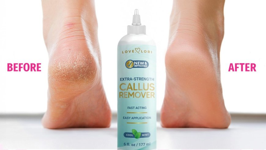 This Salon-Quality Callus Remover Dissolves Thick Dead Skin — On Sale for $9