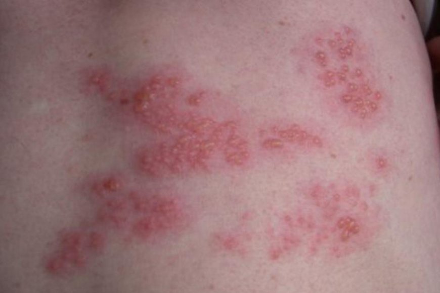 帶狀疱疹防治關鍵　疫苗接種是最佳保護