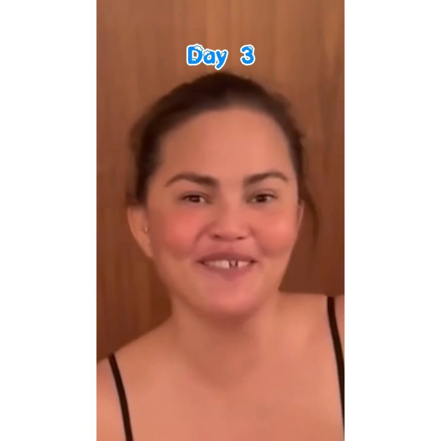 Chrissy Teigen Knocks Out Her Own Front Tooth in Candy Cane Mishap