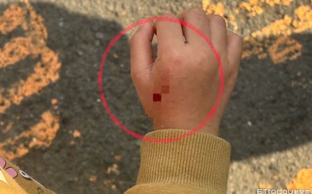 一句道歉都沒有！4歲女童遭柴犬咬傷　家屬不滿飼主冷處理提告