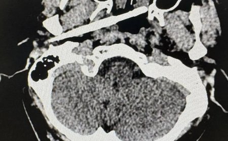 男子被一根筷子从耳部插入颅底 距动脉仅5毫米 医生成功救回