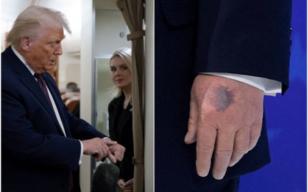 川普手背驚現「超大瘀青」！　自爆每天吞高劑量阿斯匹靈