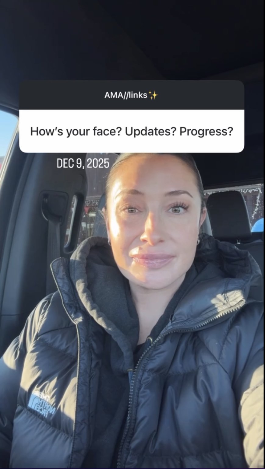 Bristol Palin Shares Update on Facial Paralysis After 1 Year