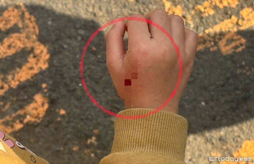 一句道歉都沒有！4歲女童遭柴犬咬傷　家屬不滿飼主冷處理提告