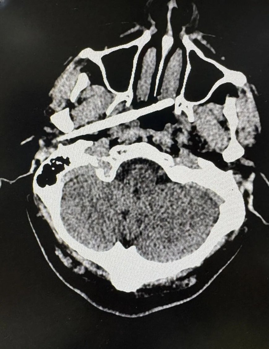 男子被一根筷子从耳部插入颅底 距动脉仅5毫米 医生成功救回