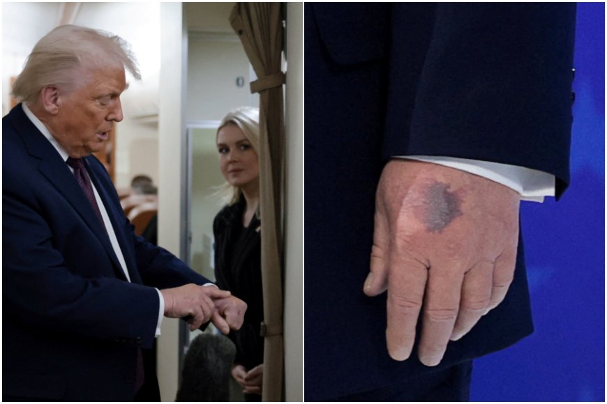 川普手背驚現「超大瘀青」！　自爆每天吞高劑量阿斯匹靈